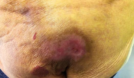 Nursing Home Neglect The Care Plan and Bed Sores Part III
