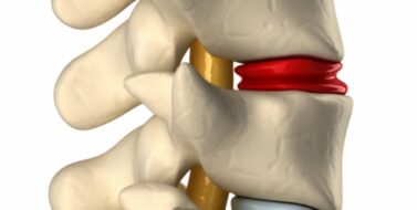 3d view of degenerated disc in spine