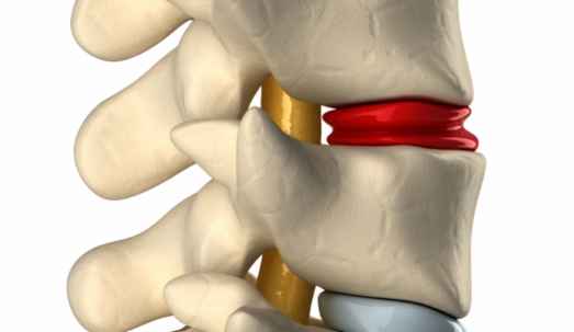 3d view of degenerated disc in spine