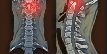 CT C-Spine or Cervical spine Coronal view in patient trauma cervical spine injury showing odontoid process or dens